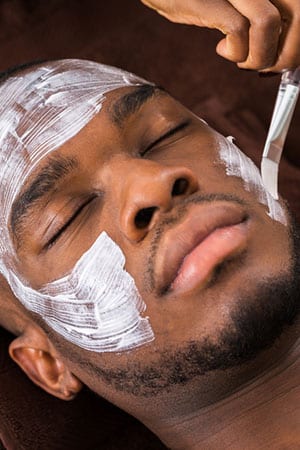 chemical peel