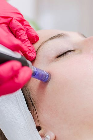 microneedling
