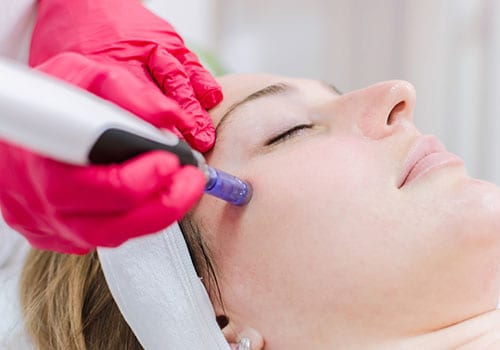 microneedling2